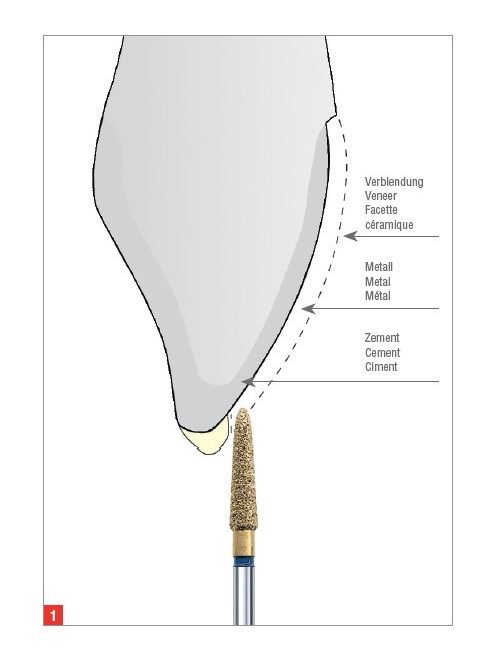 Edenta C34.314.010 koronafelvágó